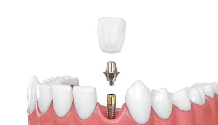 How long to recover from dental implant surgery