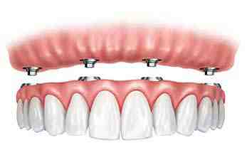 How many implants are needed for bottom dentures?