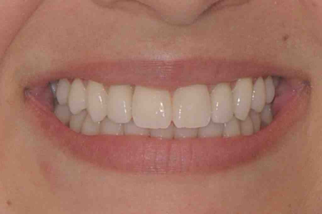 How many implants are needed for permanent dentures?
