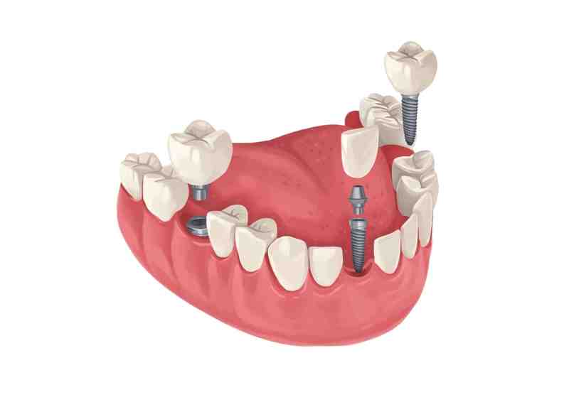 How many teeth are in All-on-4?