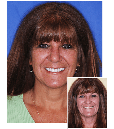 How many teeth can you attach to one implant?