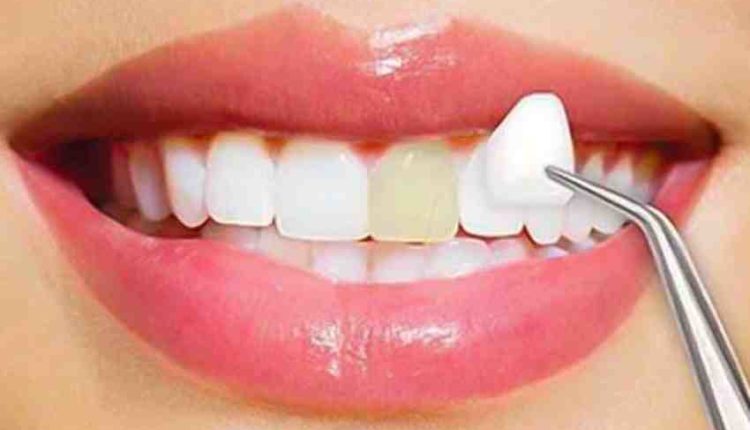 How many teeth do you put veneers on?