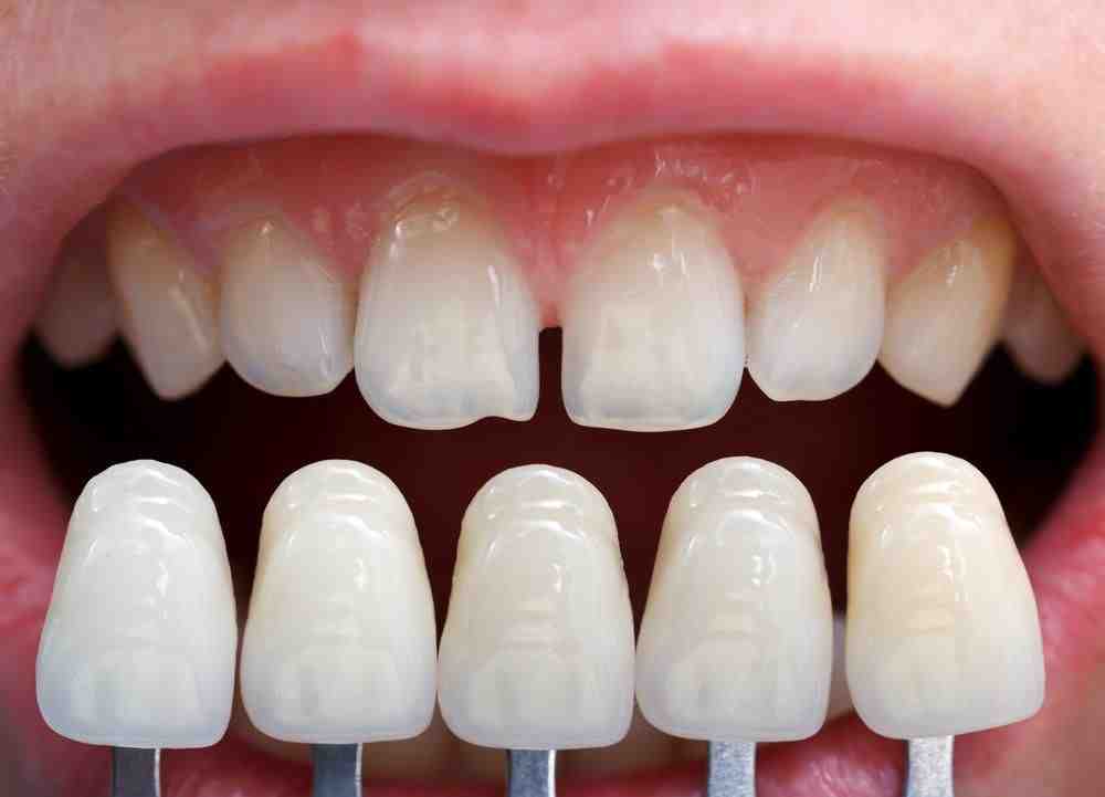 Do they shave your teeth for veneers? Dental News Network