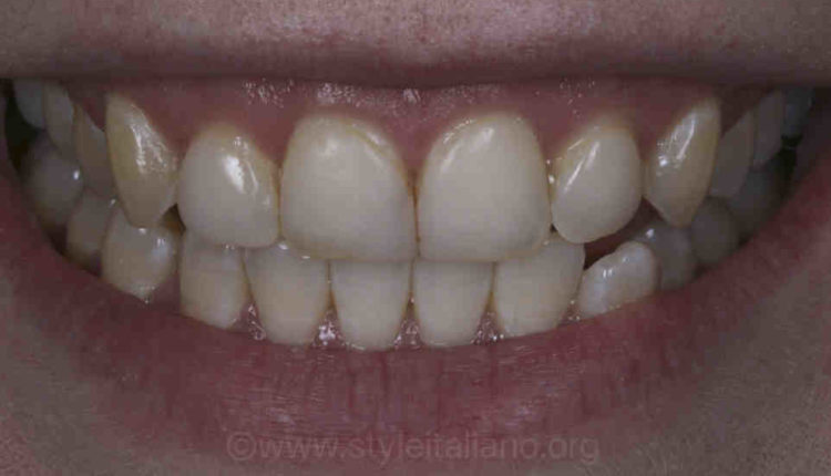 How many times can you redo veneers?
