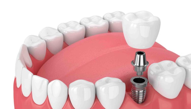 How many to dental implant