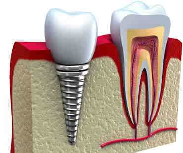 How much do dental implants cost?