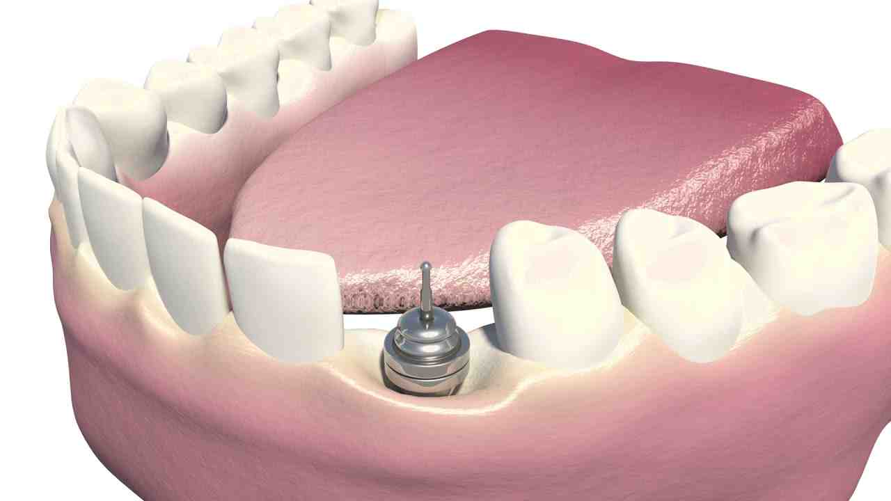 How much do full dental implants cost in Mexico?