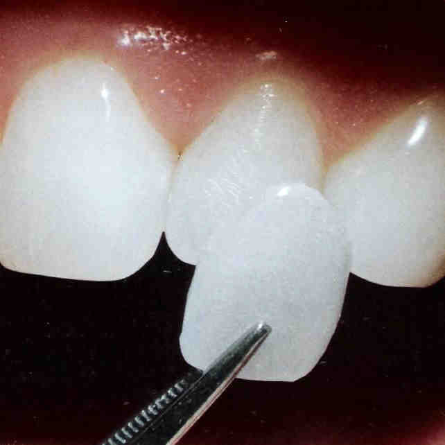 How much is it to get veneers in Mexico? Dental News Network