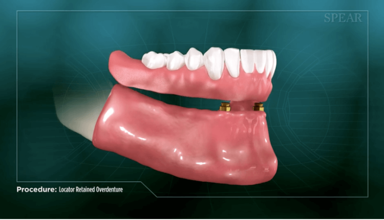 How much does dental implant cost 2019