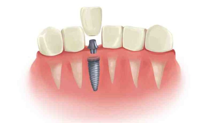 How much does it cost to glue a dental implant