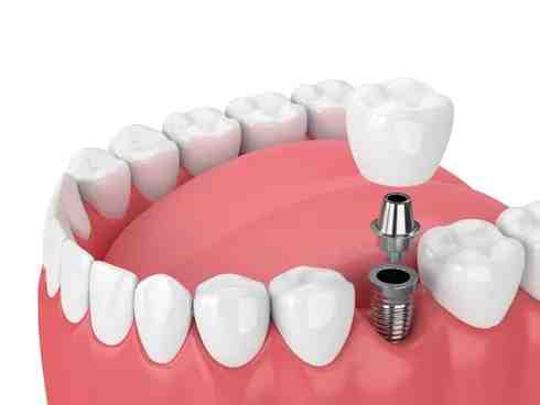 How much does it cost to replace a full set of teeth?