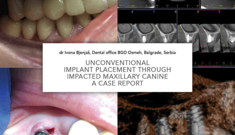 How much for all on 4 dental implants guatemala