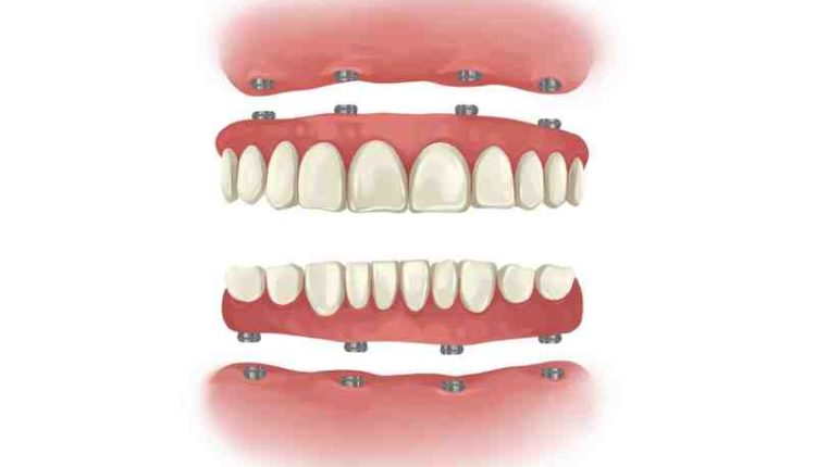 How much full dental implants