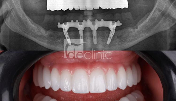 How much have dental implants gone down over the last 6 years