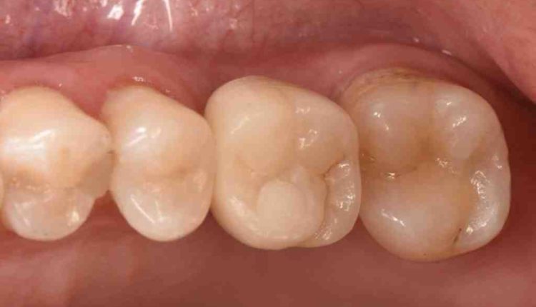 How much is a dental implant georgetown texas