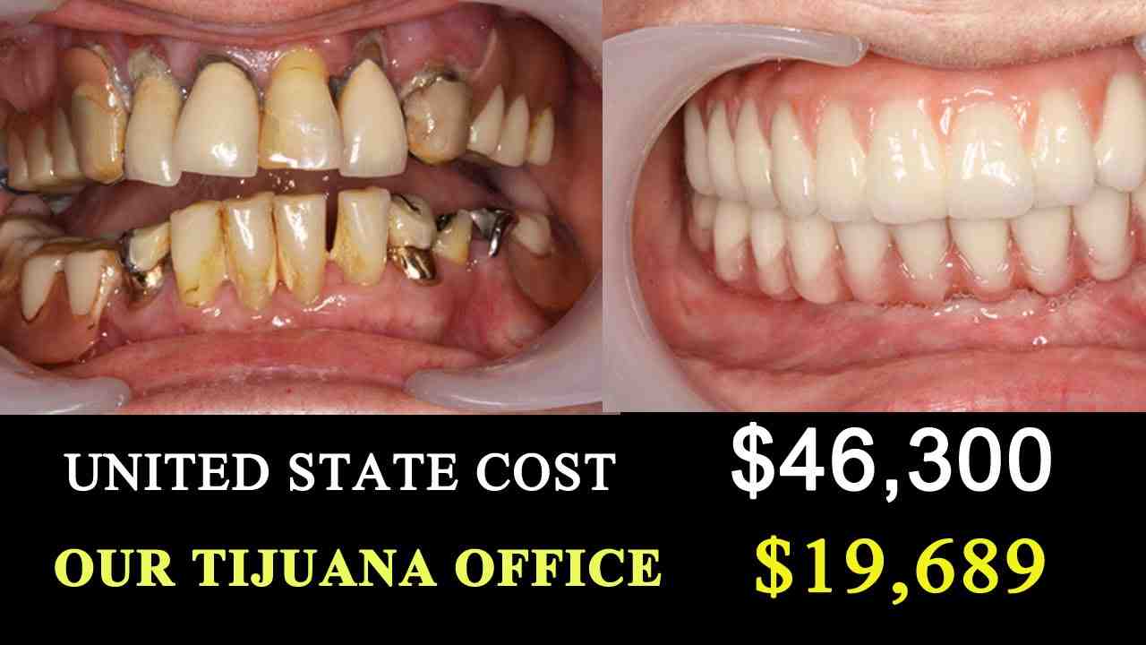 How much is it to get veneers in Mexico? Dental News Network