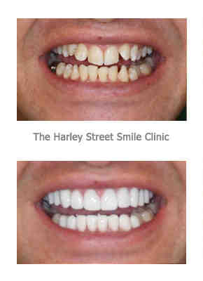 How much is a full set of veneers?