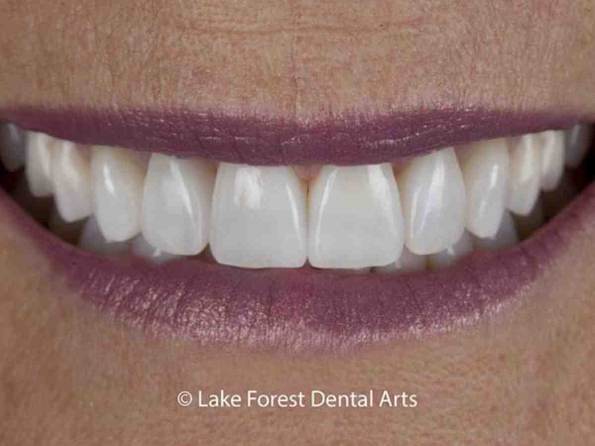 Are teeth veneers worth it? Dental News Network