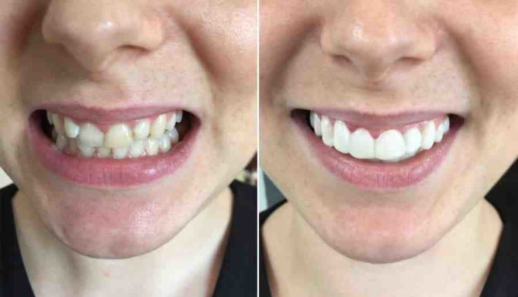 How much is it to get veneers in Mexico?