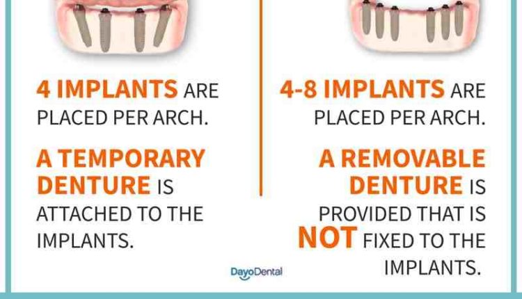 How much to charge for all on 4 dental implants