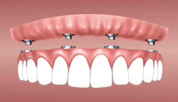How muxh so dental implants cost?