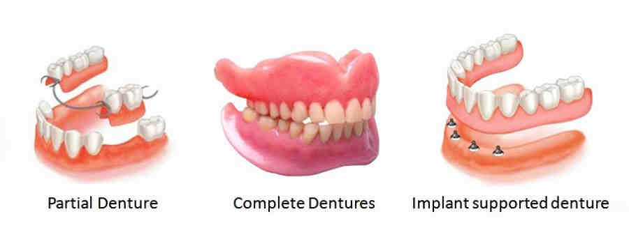 What type of dentures are the best? - Dental News Network