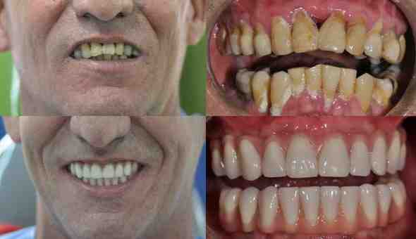 How painful is a tooth implant?
