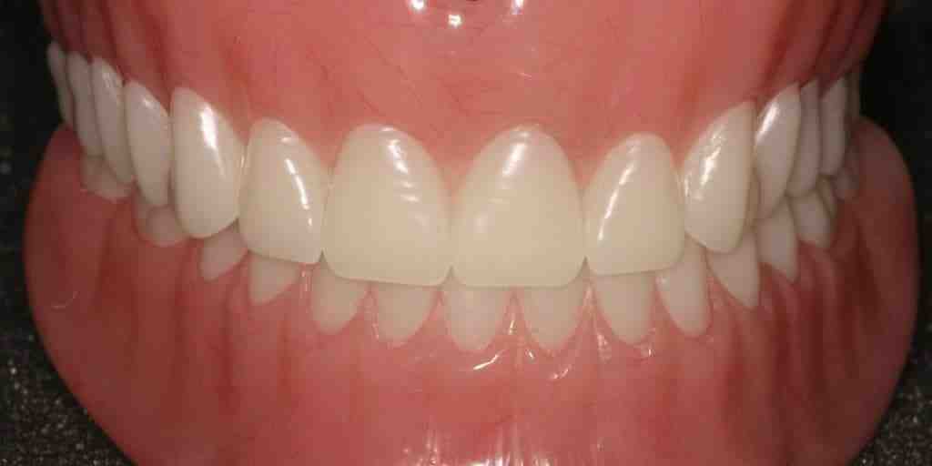 Can dentures be fitted immediately? Dental News Network