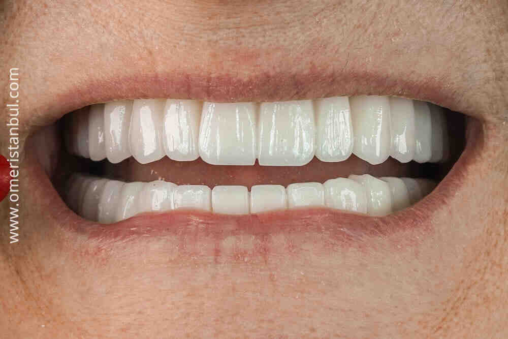 How soon after tooth extraction can you have an implant UK?