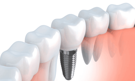How soon after tooth extraction can you have implant?