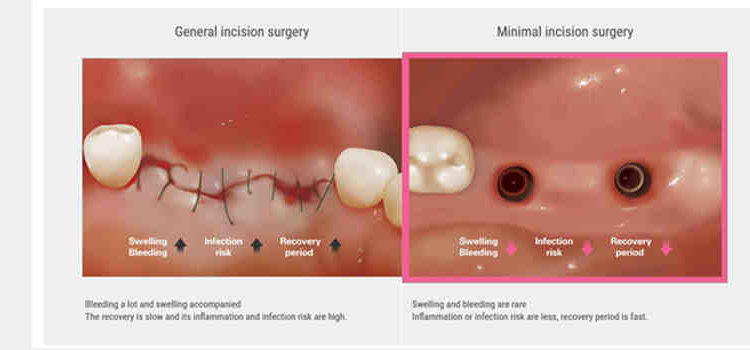 How to add dental implants to your business
