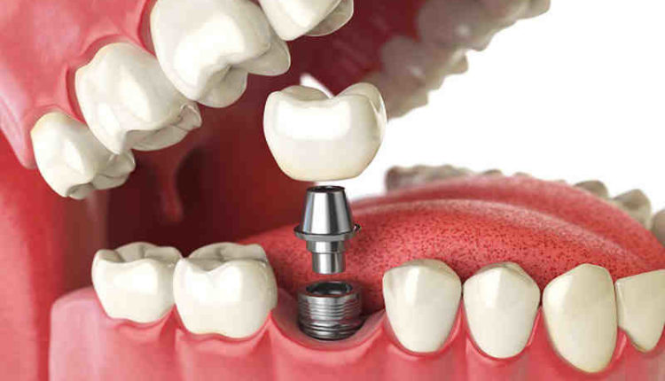 How to attach crown to dental implant