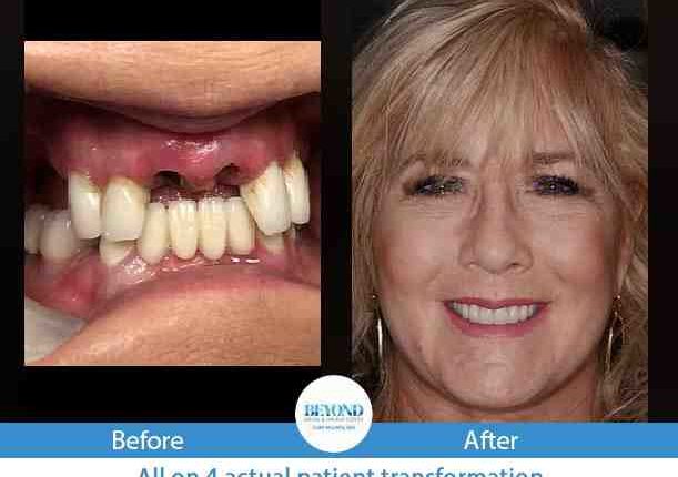 How to get help with dental implants