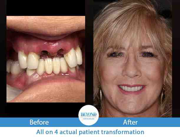 how-to-get-help-with-dental-implants-dental-news-network
