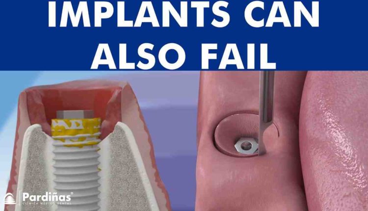 How to get rid of dental implant infection