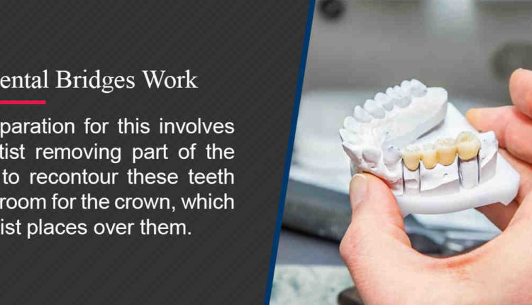 How to get the cheapest dental implants or crowns in maryland