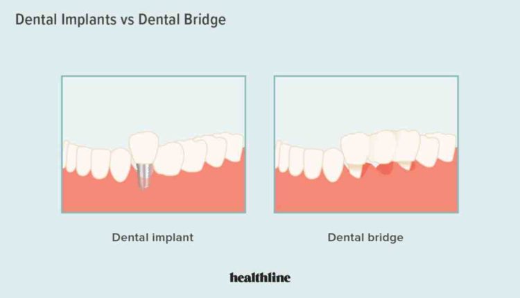 How to make your own dental implants