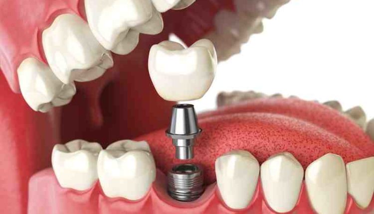 How to prevent infection after dental implant