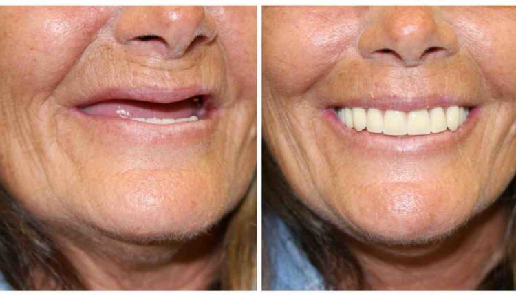 How to remove all on four dental implants ?