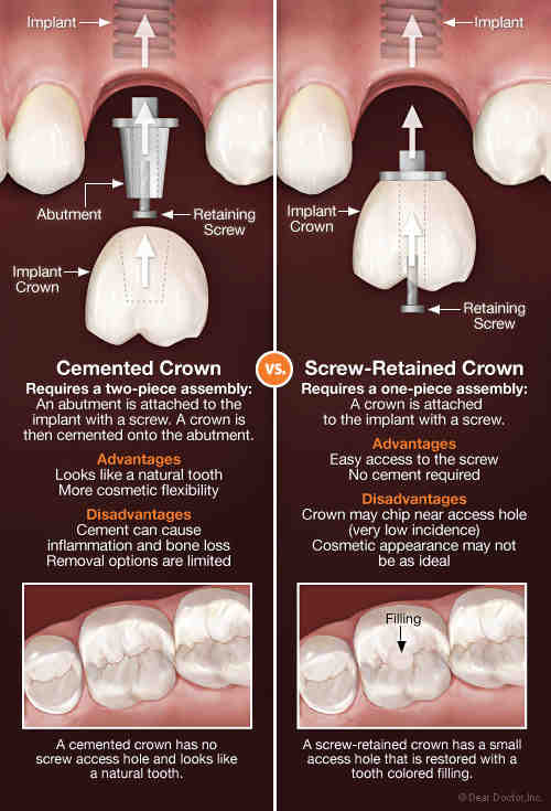 How To Remove Dental Implant Abutments Dental News Network