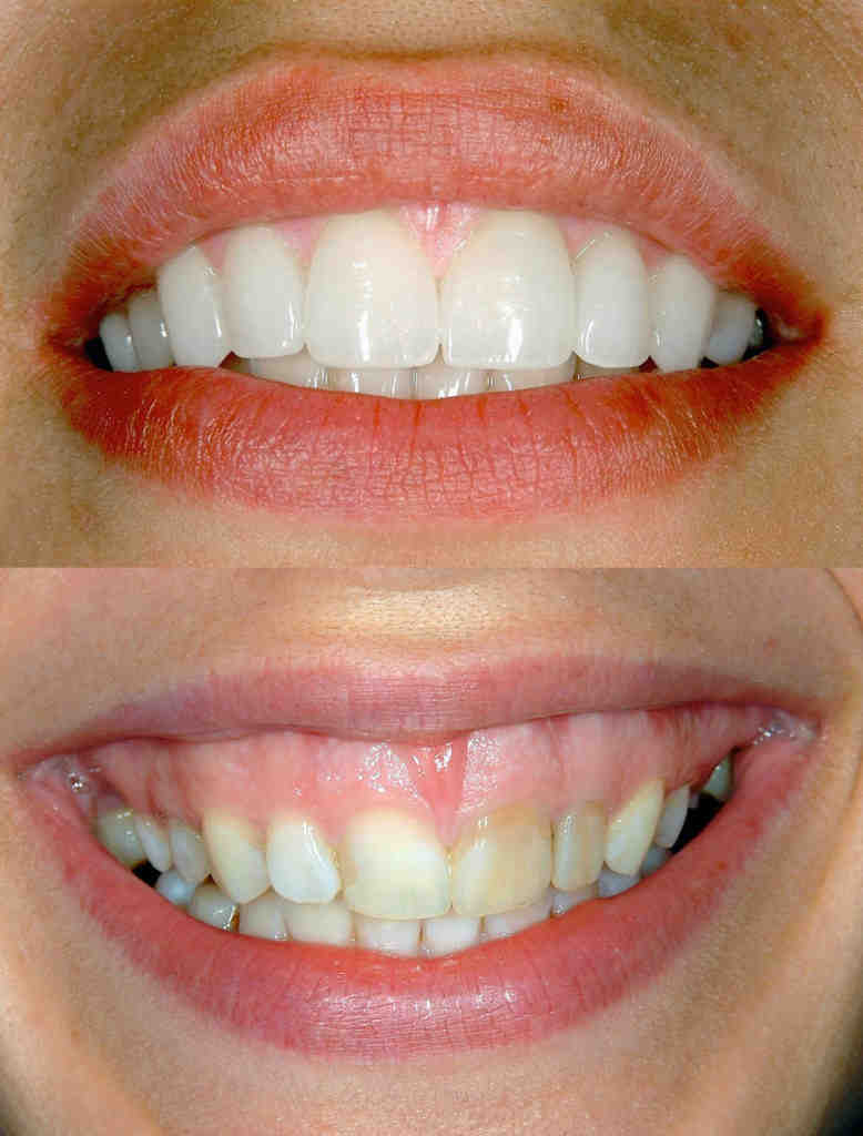 Do your teeth rot under veneers? Dental News Network