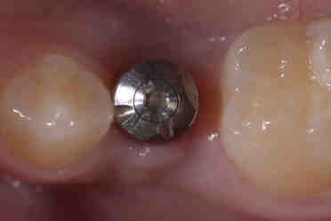 Is CBCT scan harmful?