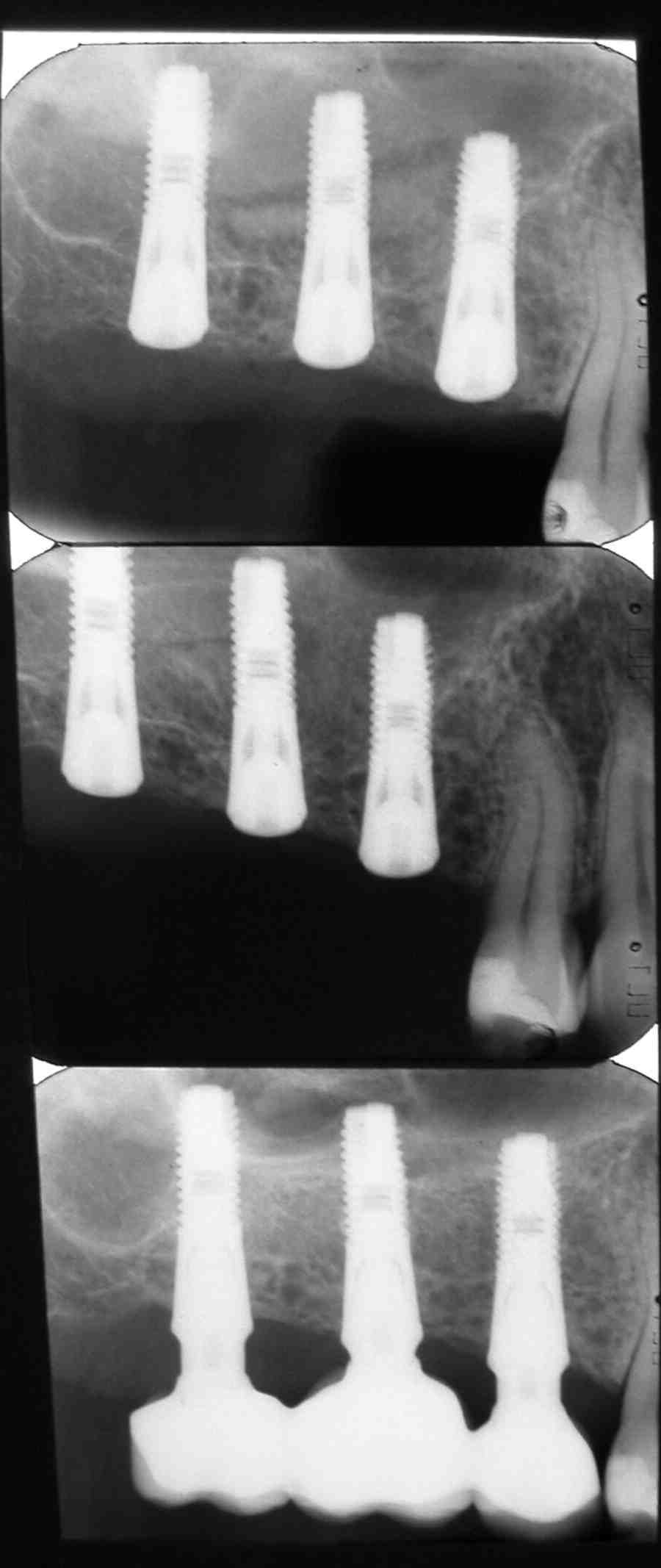 Is there an issue if a dental implant the sinus cavity