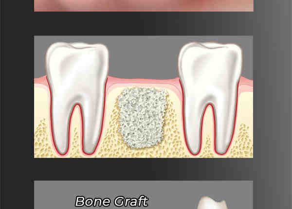 Is bone grafting for dental implant painful
