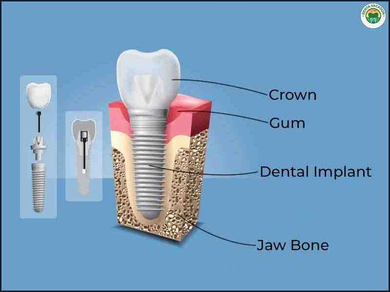 Is it worth going to Mexico for dental implants?