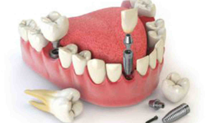 Is the insurance cover dental implants