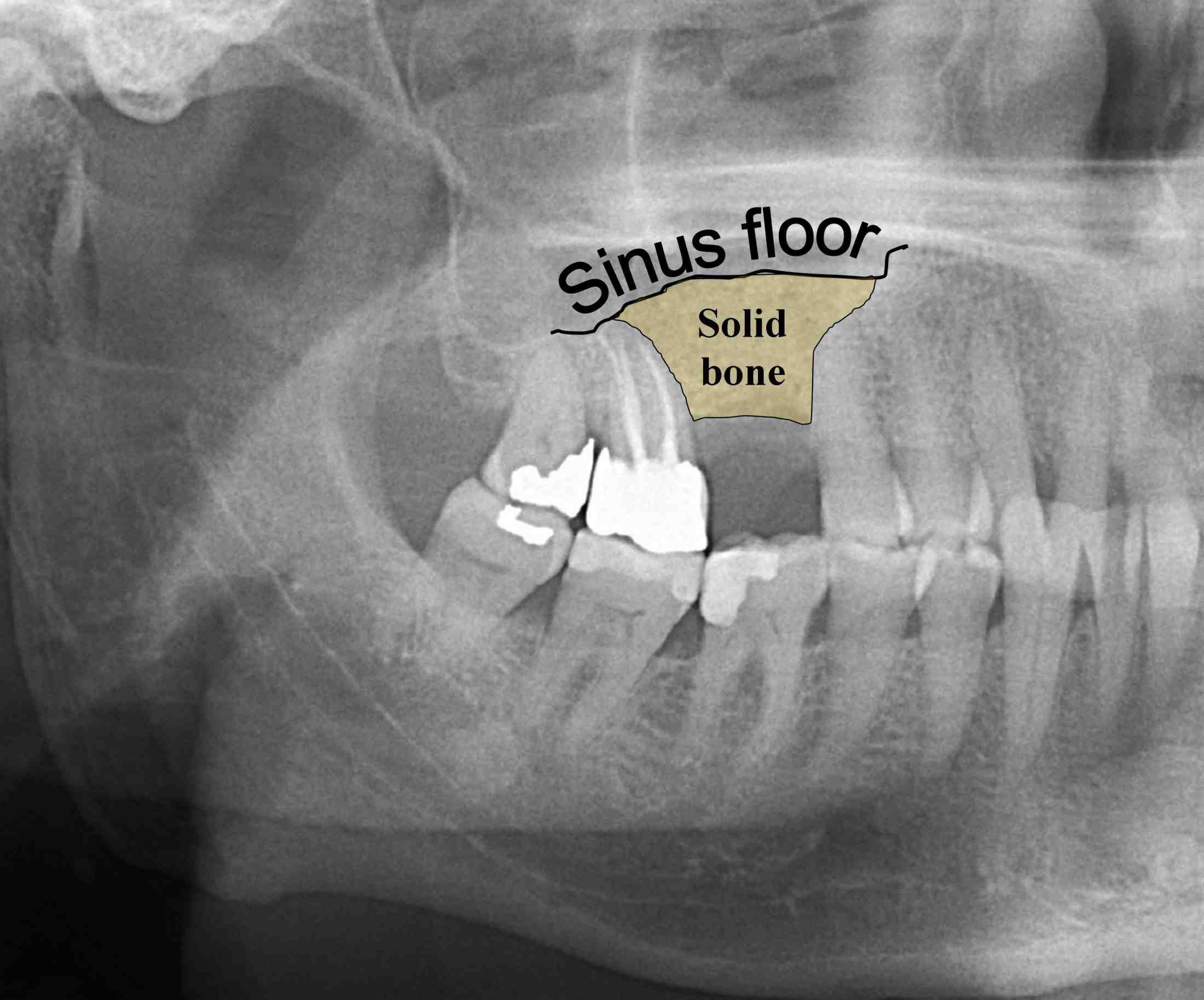Do most dental implants need bone graft? Dental News Network