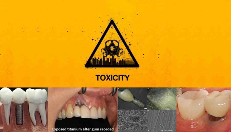 Titanium dental implants and metal reaction like hip?