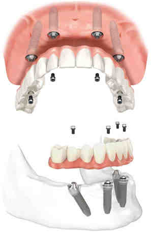 What are Allergan implants made of?