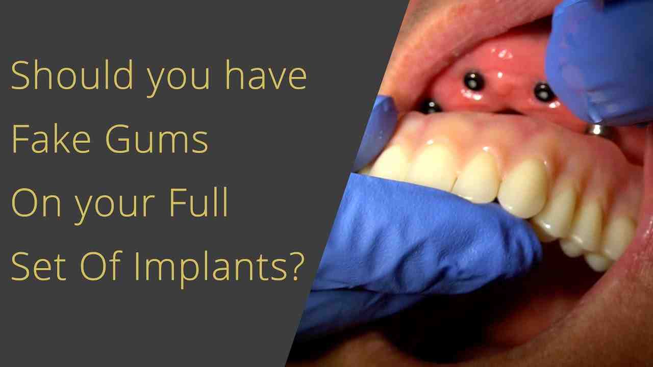 do-dental-implants-have-fake-gums-dental-news-network